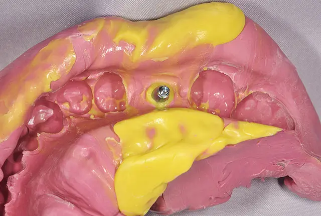 ３M社製シリコン印象材２