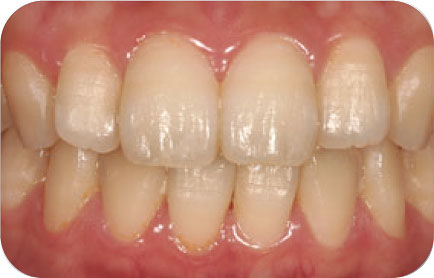 ホワイトニング