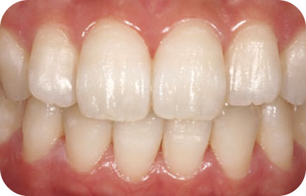 ホワイトニング