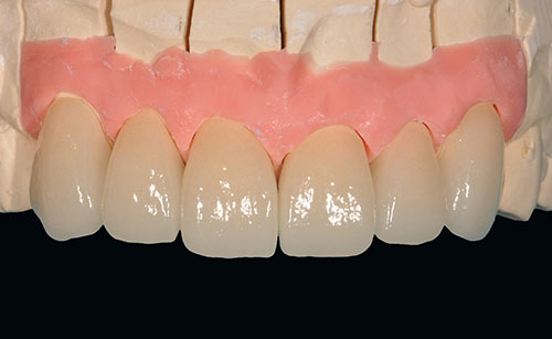 かぶせ物により歯の形と色を改善