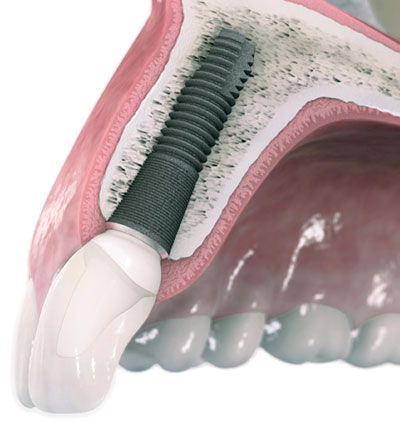 末永く安心して使えるインプラントを