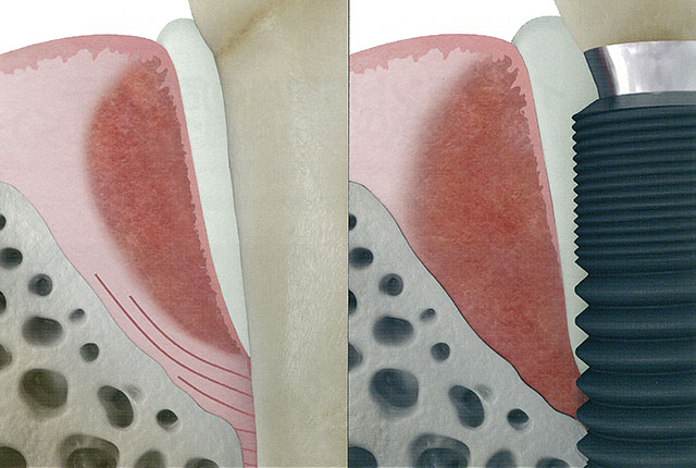 歯周病（左）、インプラント周囲炎（右）